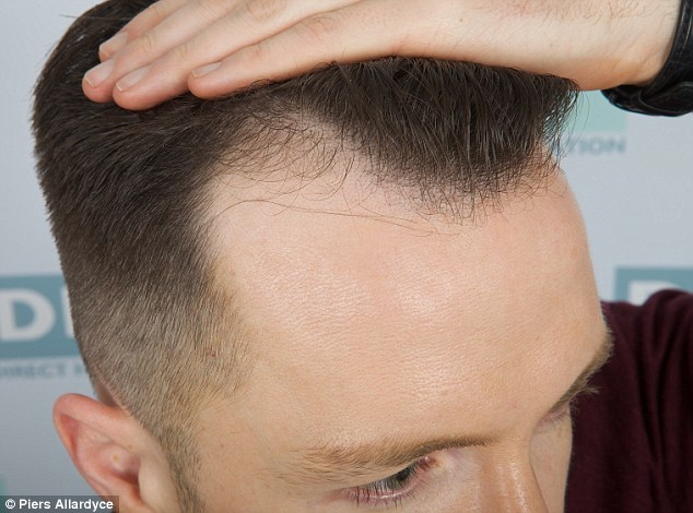 hair regrow on bald spots